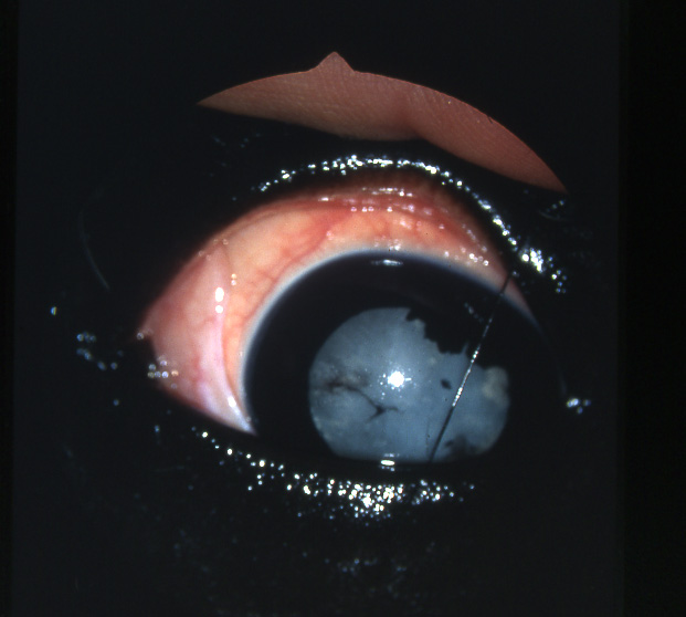 uveite maladie de l'oeil